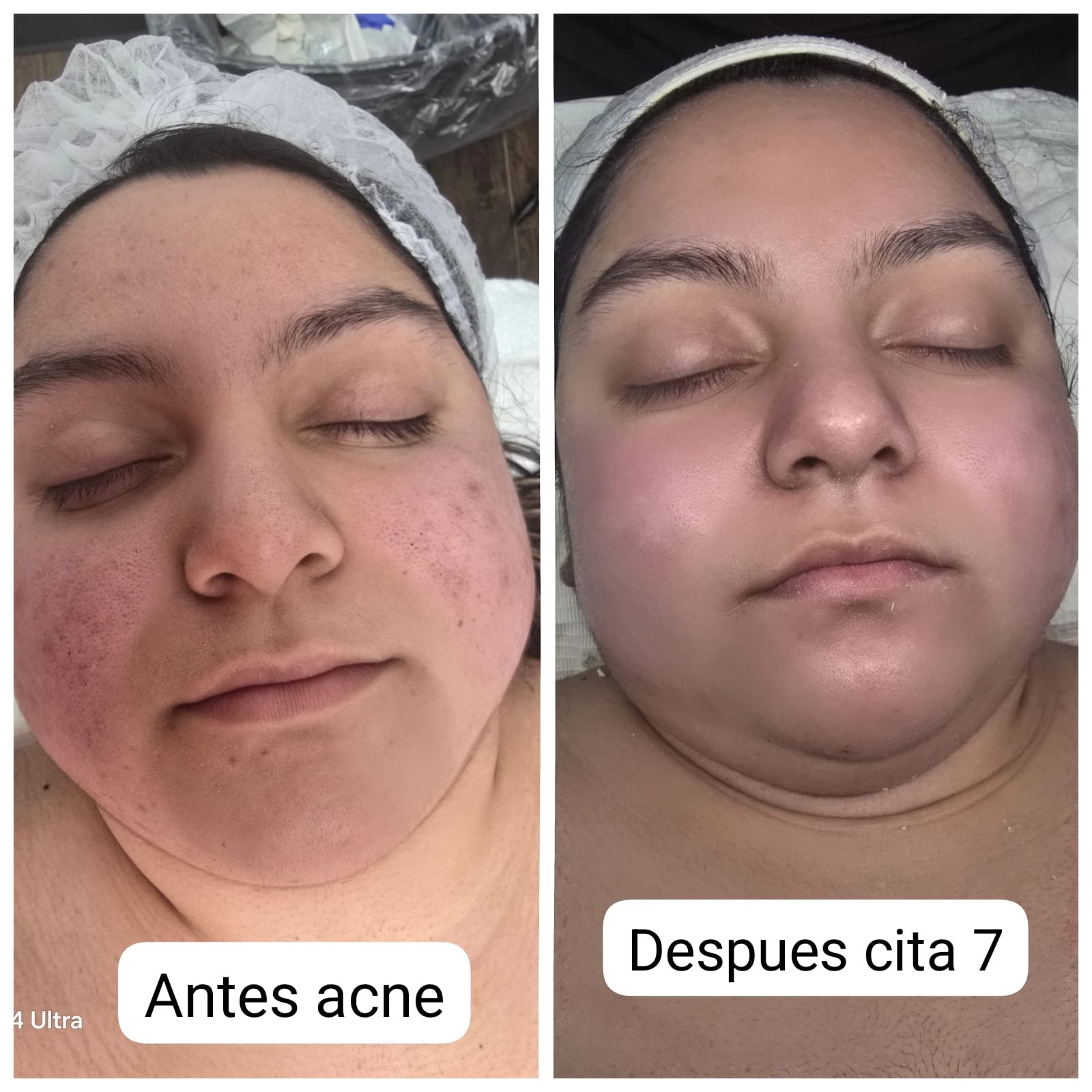 Acne care before-and-after photographs supplied by Varua Spa