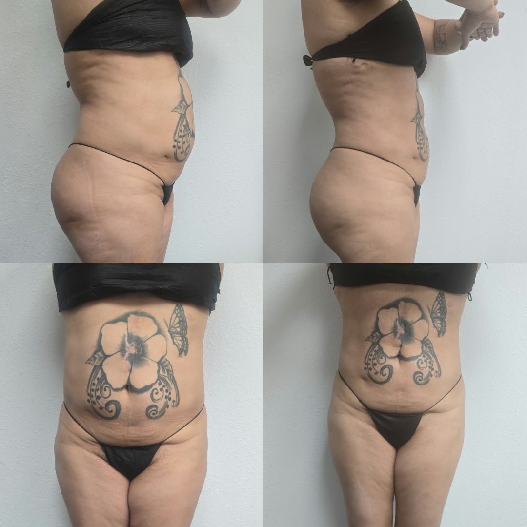 Body sculpting before-and-after photographs supplied by Varua Spa