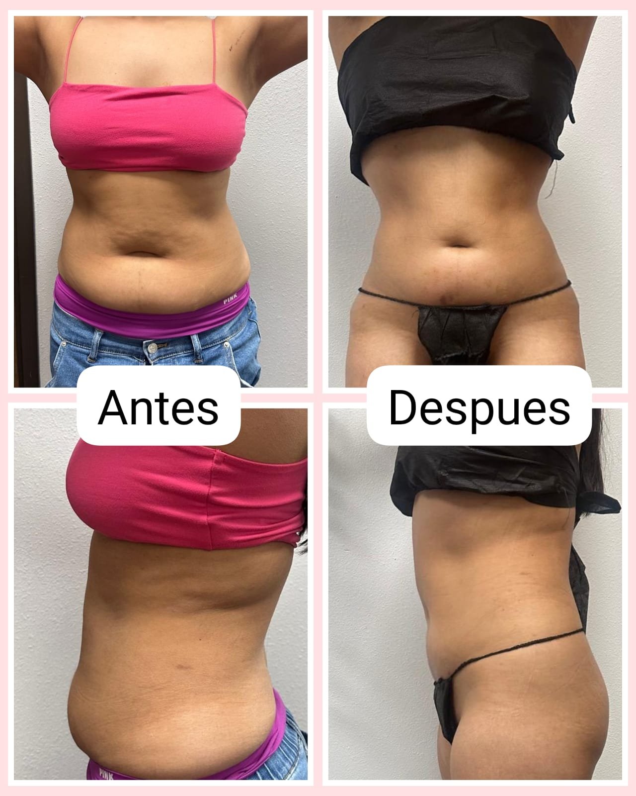 Body contouring before-and-after photographs supplied by Varua Spa