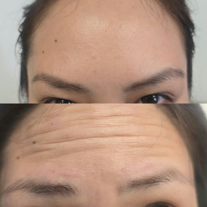 Smoother-looking skin before-and-after photographs supplied by Varua Spa