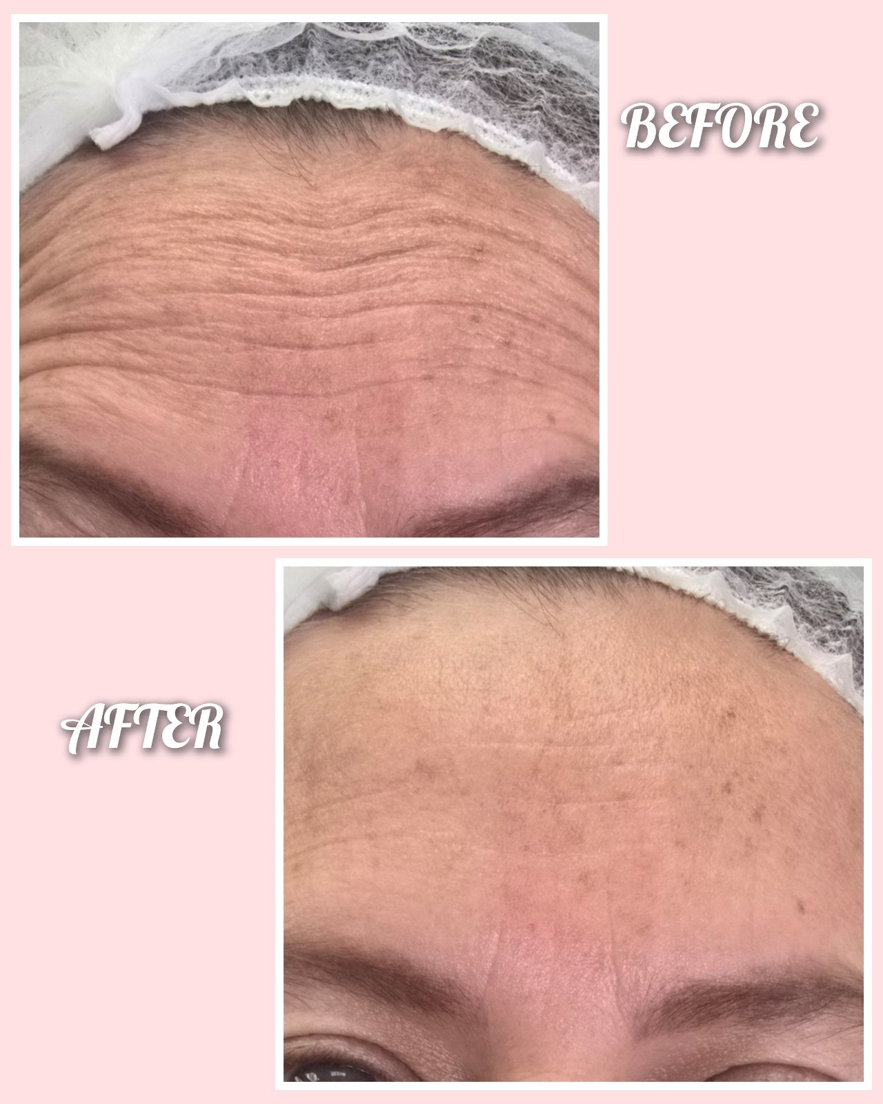 Skin renewal before-and-after photographs supplied by Varua Spa